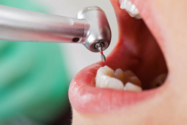 Best Emergency Wisdom Teeth Removal in Walworth, WI